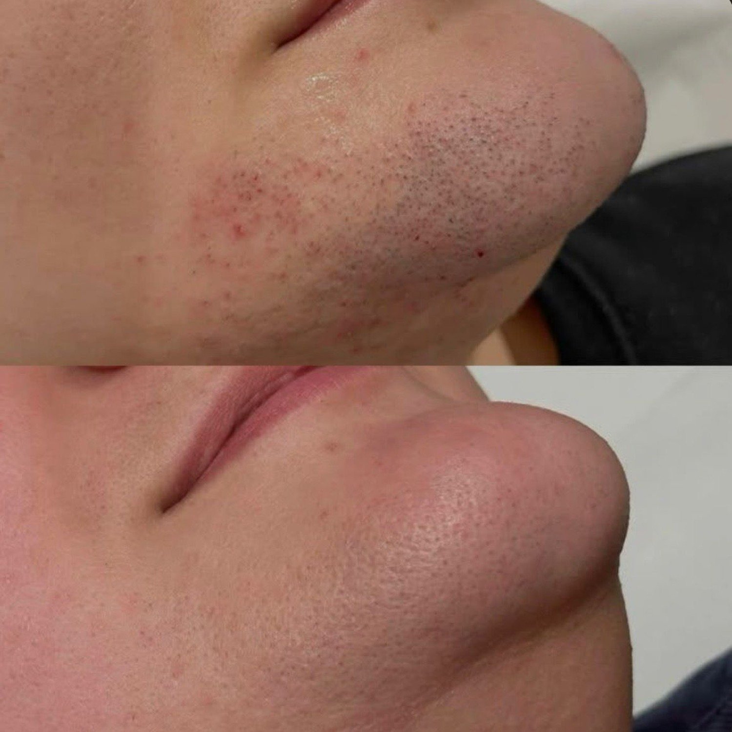 Láser Facial por Zona